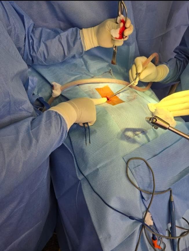 Premier cas de chirurgie  mini-invasive au CHU- Renaissance